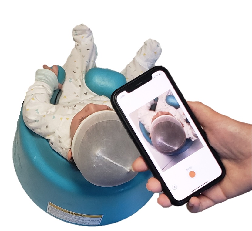 A hand holds a smartphone using the SoftSpot app, which is taking video of a baby's headshape